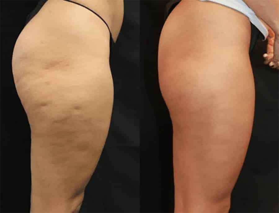 Cellulite Treatments